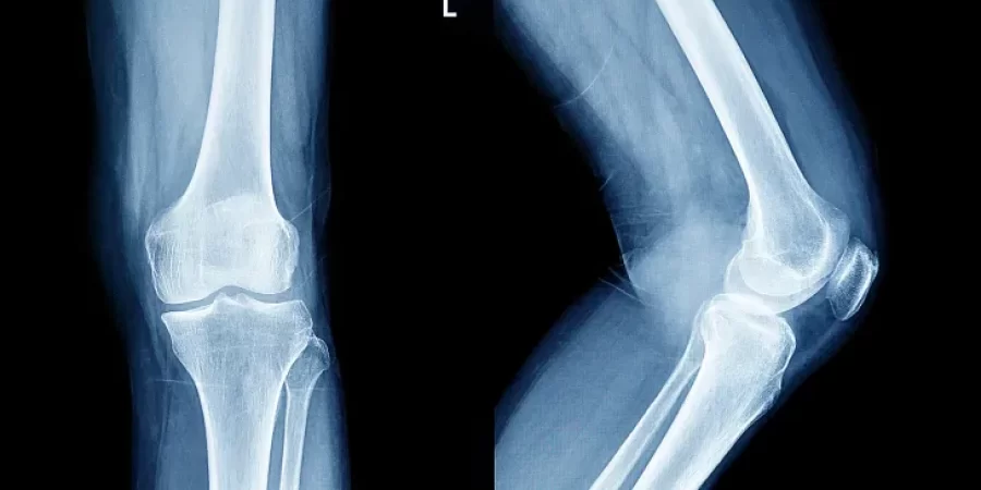 هشاشة العظام