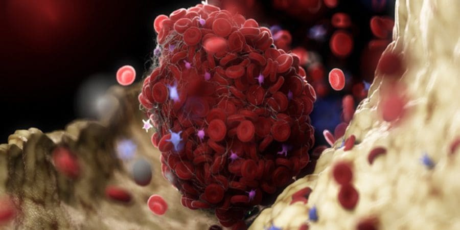 السكتات الدماغية