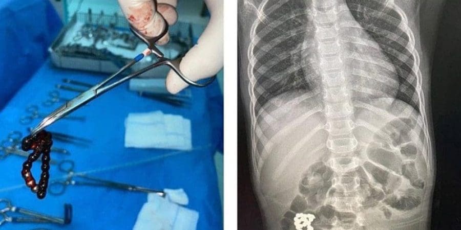 مفاجأة في أمعاء طفل