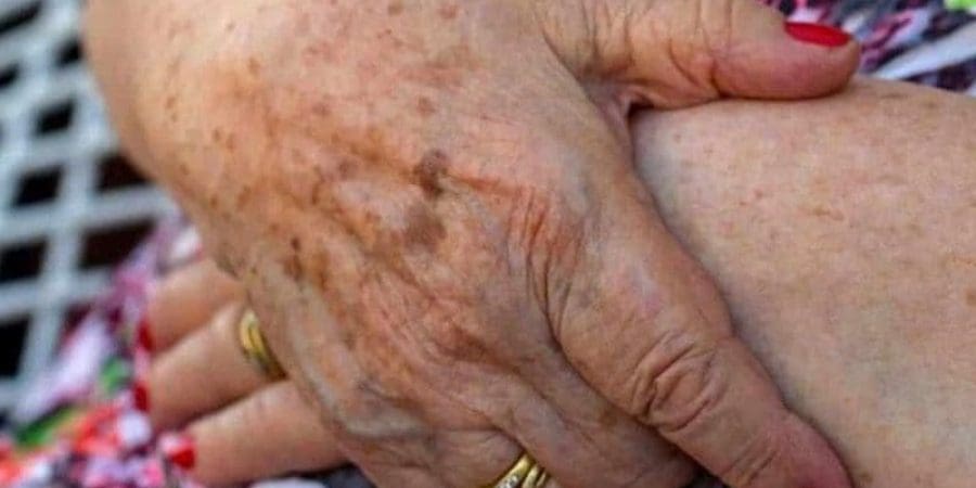 يجب استشارة طبيب الأمراض الجلدية إذا كانت البقعة تنمو بشكل أكبر أو يتغير لونها