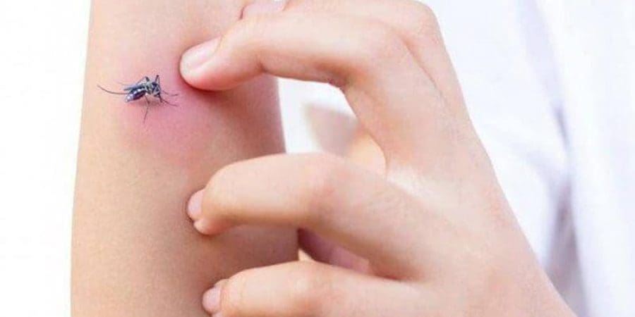لدغات البعوض هي السمة المميزة لفصل الصيف الحار