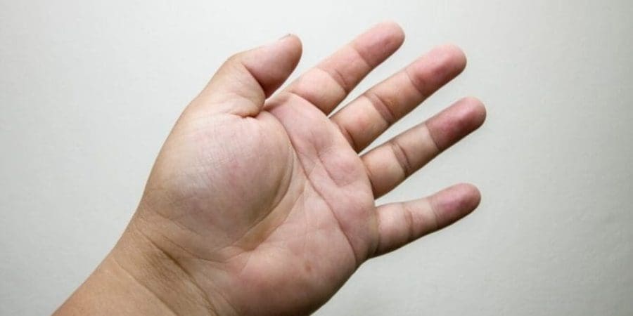 تورم الأصابع