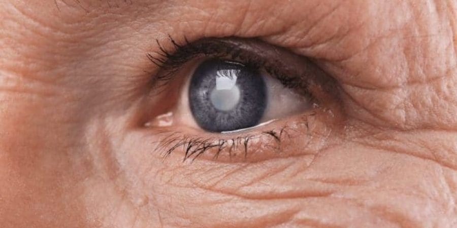 الغلوكوما، تعبيرية