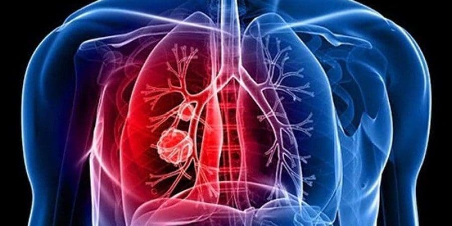 سرطان الرئة | تعبيرية