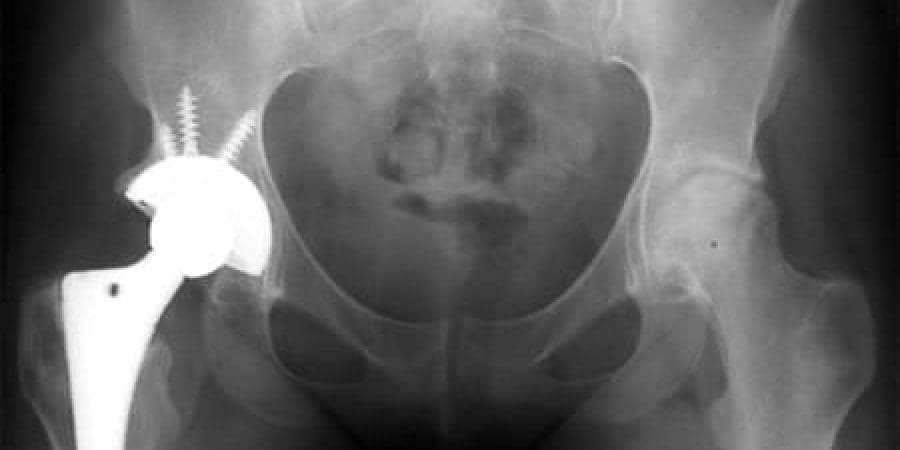 استبدال كامل لمفصل الورك