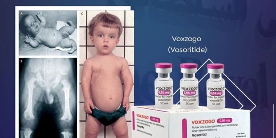 انجاز طبي رائد في علاج التقزم الوداني للأطفال بدواء "فوسوريتيد"